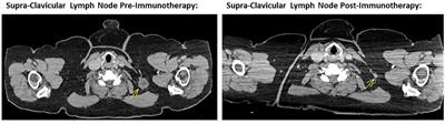 Case report: A rare case of immunotherapy induced isolated left CN VI palsy in a patient with unresectable melanoma